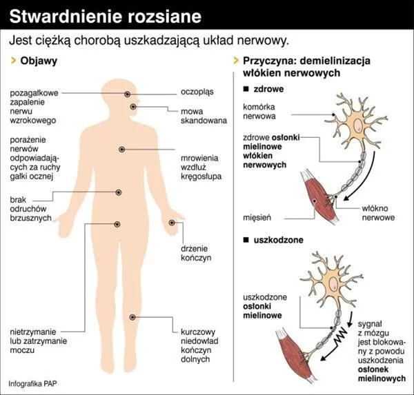 Zdjęcie Jakie są pierwsze objawy stwardnienia rozsianego? Lista kluczowych oznak