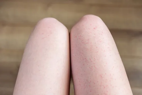 Zdjęcie Jak pielęgnować skórę po depilacji depilatorem, aby uniknąć podrażnień