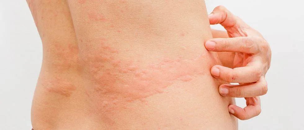 Zdjęcie Rumień nagły u dorosłych objawy - jak je rozpoznać i leczyć