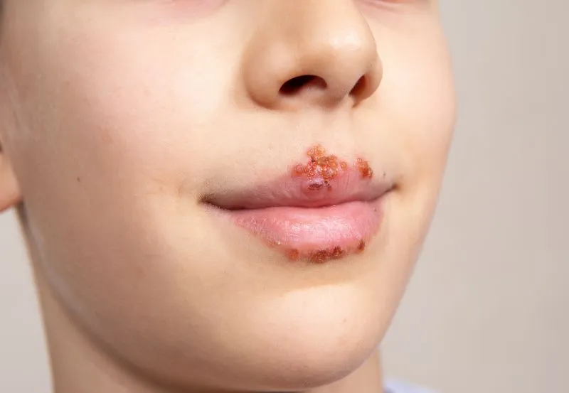 Zdjęcie Jak zażywać heviran przed makijażem permanentnym ust, aby uniknąć opryszczki