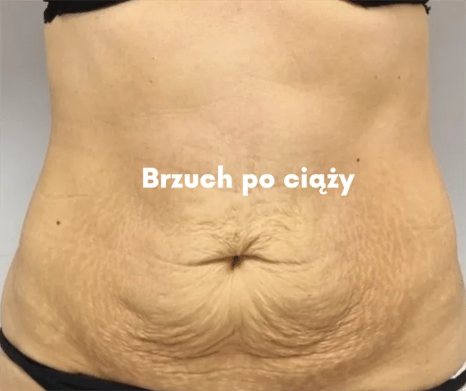 Zdjęcie Jak wygląda brzuch po porodzie i co możesz zrobić, by go poprawić