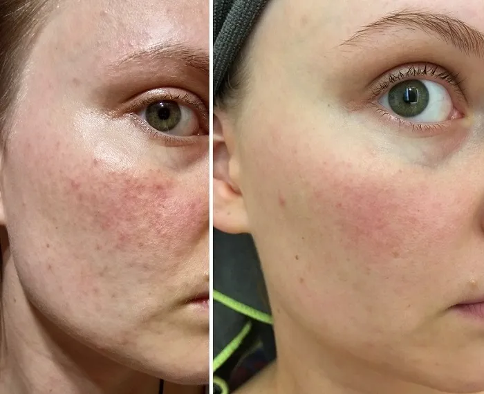 Zdjęcie Retinol w kosmetologii: Jak stosować i jakie efekty osiągnąć