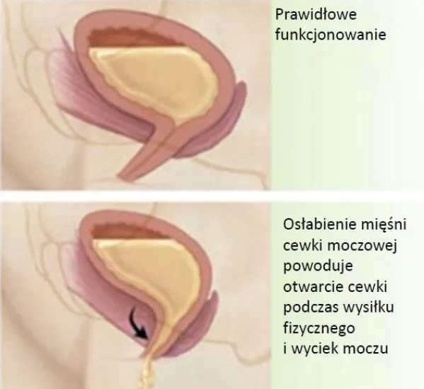 Zdjęcie Nietrzymanie moczu u kobiet: przyczyny i skuteczne leczenie