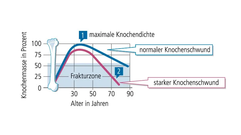 Zdjęcie Osteoporose Diagnostik: Wichtige Tests und Risikofaktoren verstehen