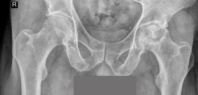 Zdjęcie Obluzowanie endoprotezy stawu biodrowego objawy, które powinny niepokoić