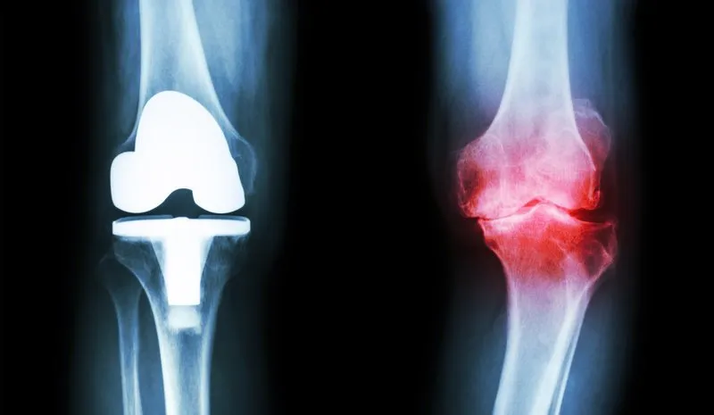 Zdjęcie Jakie badania na zwyrodnienie stawów pomogą uniknąć bólu i dyskomfortu