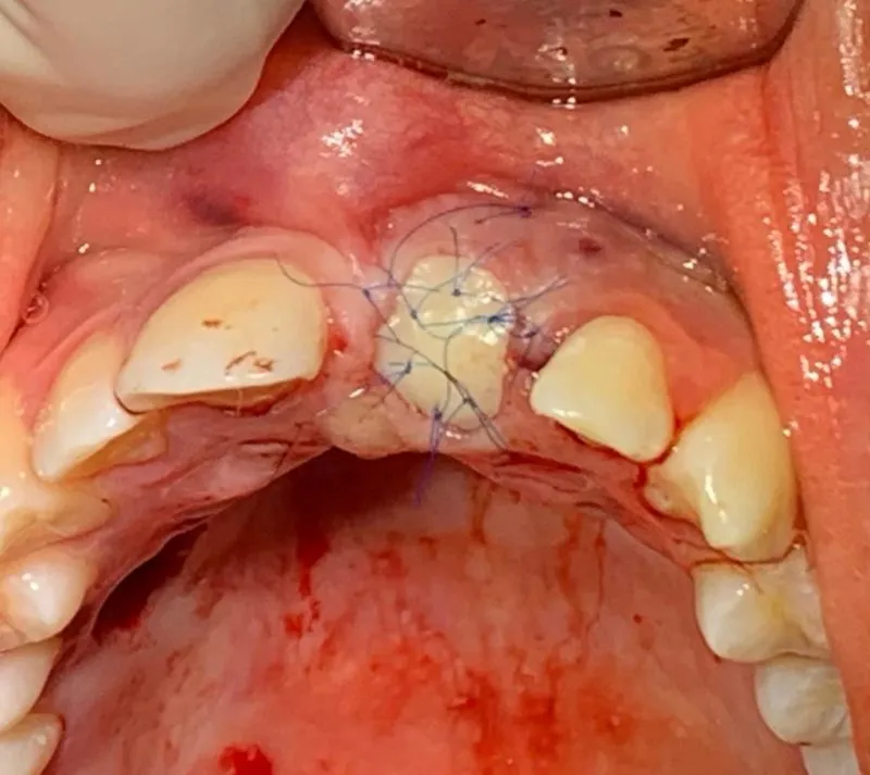 Zdjęcie Jak powinno wyglądać dziąsło po wyrwaniu zęba - objawy i komplikacje
