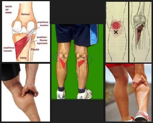Zdjęcie Todo sobre el músculo poplíteo: anatomía, función y lesiones comunes