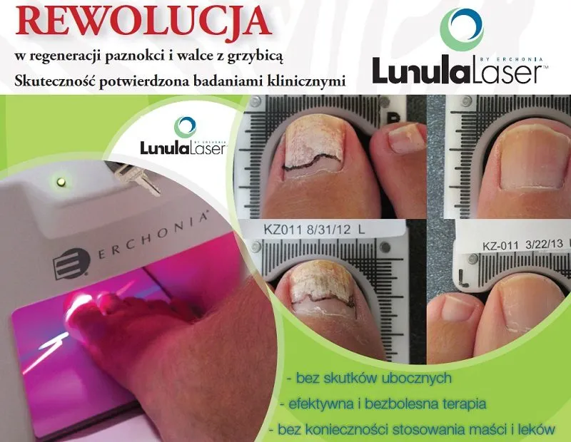 Zdjęcie Czy podolog jest na NFZ? Poznaj prawdę o kosztach opieki podologicznej