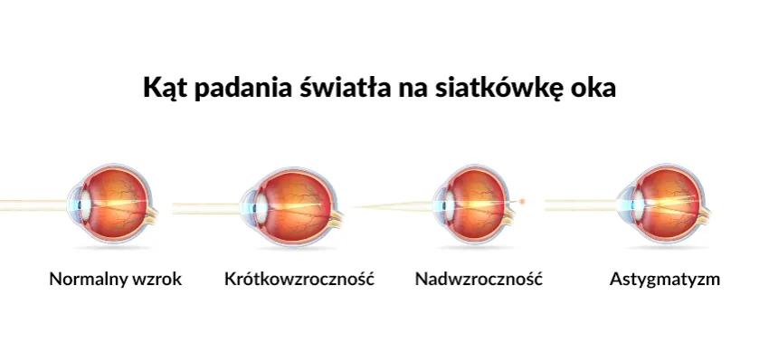 Zdjęcie Jak dobrać moc soczewki do wady wzroku i uniknąć dyskomfortu przy noszeniu