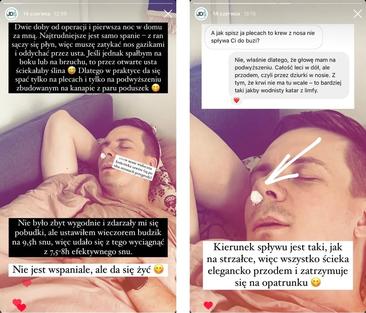 Zdjęcie Operacja przegrody nosowej ile L4: Ile dni zwolnienia potrzebujesz?
