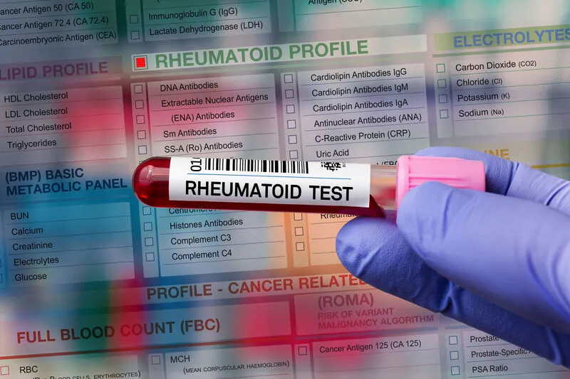 Zdjęcie Badania na zapalenie stawów: 5 kluczowych testów diagnostycznych