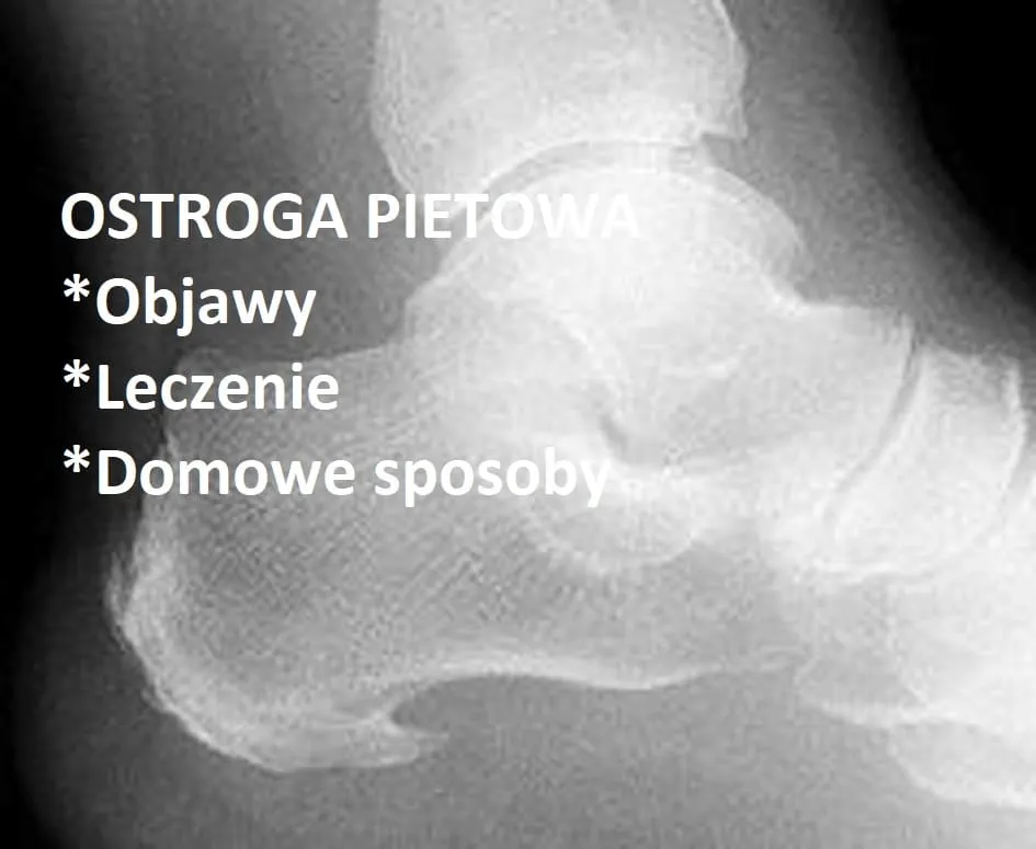 Zdjęcie Jakie leki na ostrogę piętową skutecznie złagodzą ból?