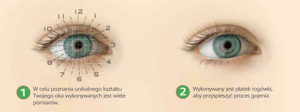 Zdjęcie Jakie wady wzroku można operować? Poznaj możliwości laserowej korekcji