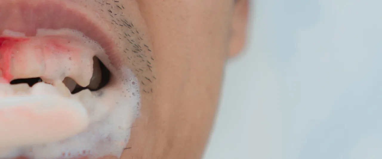 Zdjęcie Co na krwawiące dziąsła? Skuteczne metody leczenia i zapobiegania