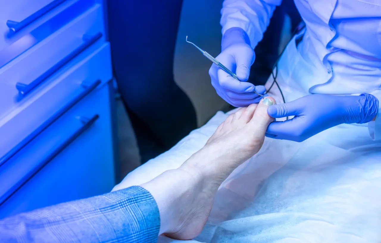 Zdjęcie Tamponada paznokcia - skuteczna metoda na wrastające paznokcie