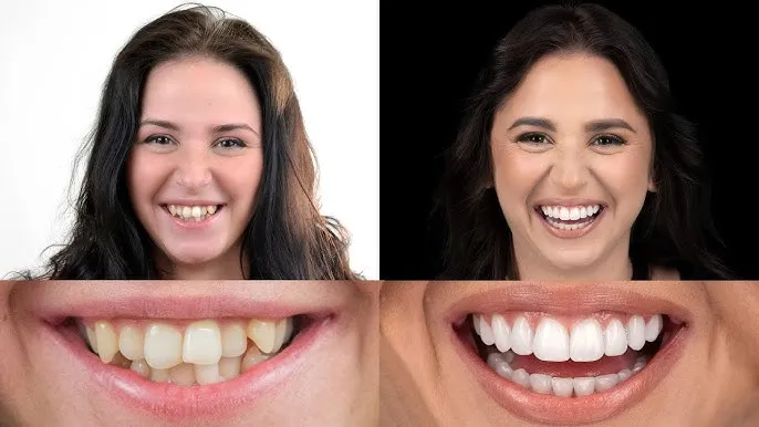 Zdjęcie Czy aparat na zęby zmienia kształt twarzy? Oto, co musisz wiedzieć