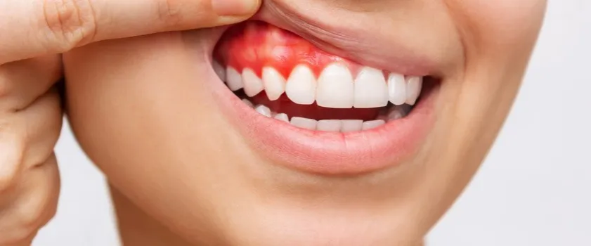 Zdjęcie Co na spuchnięte dziąsło? Skuteczne sposoby na ulgę i zdrowie