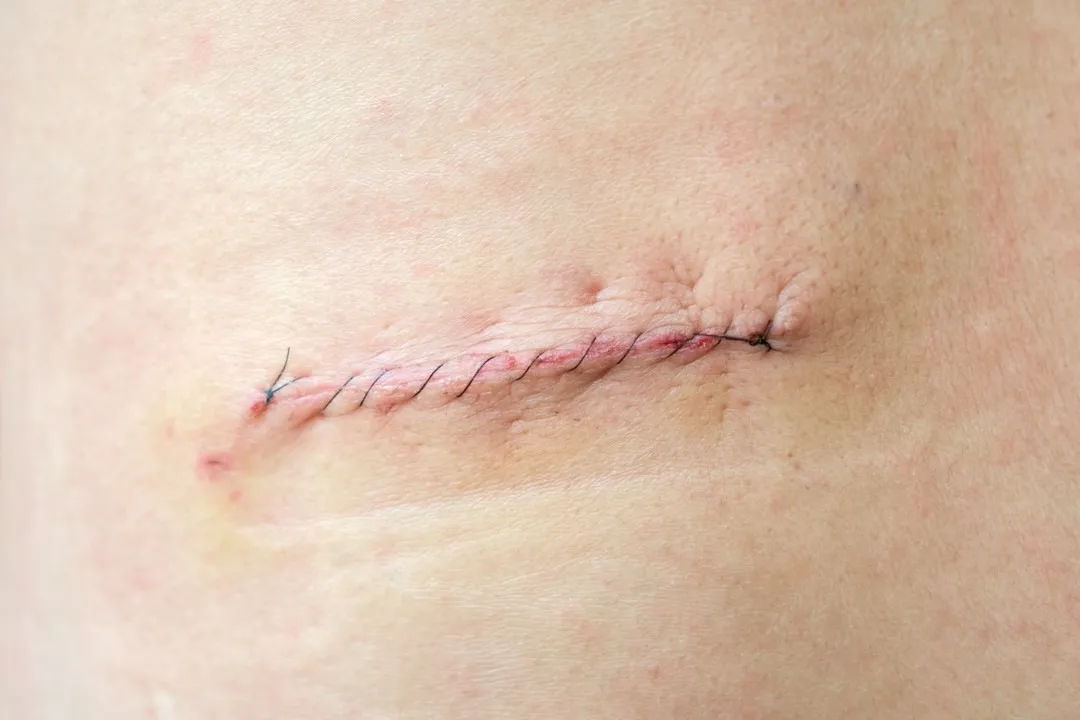 Zdjęcie Kto zdejmuje izolacje? Kluczowe informacje o usuwaniu szwów po operacji