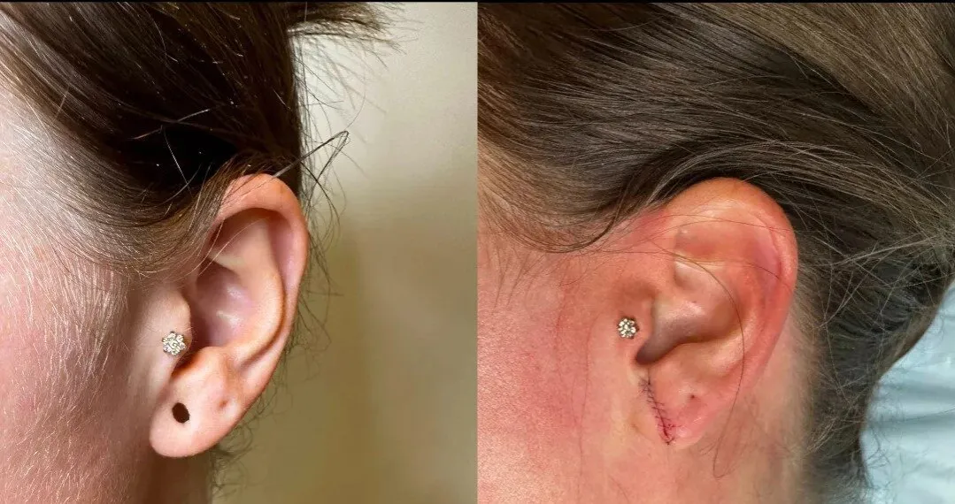 Zdjęcie Jak wyjąć kolczyk z ucha bez bólu i ryzyka infekcji