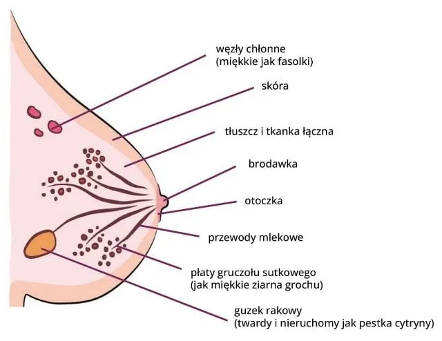 Zdjęcie Jak wygląda rak piersi - objawy, rodzaje, diagnostyka i leczenie
