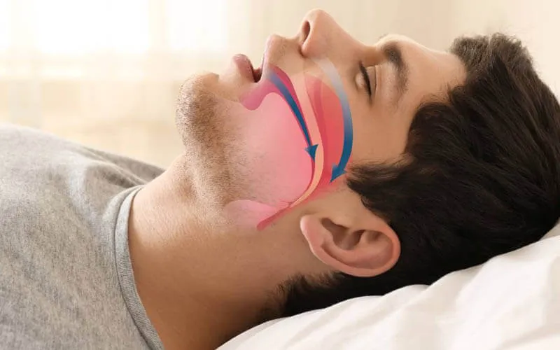 Zdjęcie Chrapanie: do jakiego lekarza się udać? Sprawdź ścieżkę leczenia