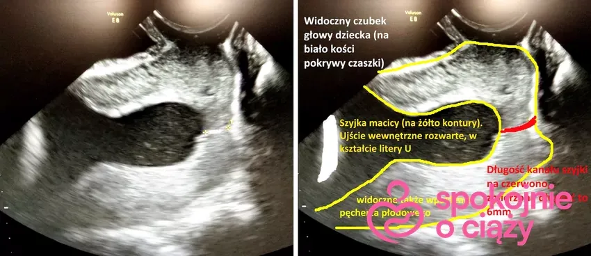 Zdjęcie Jak zmienia się szyjka macicy przed porodem? Kluczowe objawy i porady