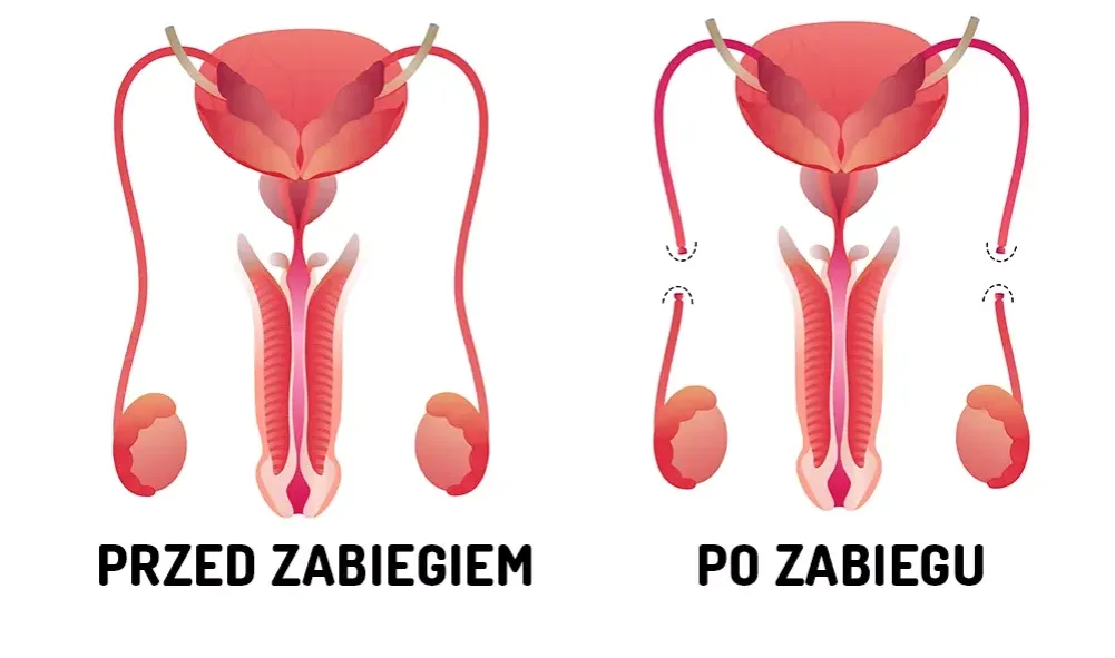Zdjęcie Czy wazektomia to grzech? Moralne dylematy i religijne spojrzenia na zabieg