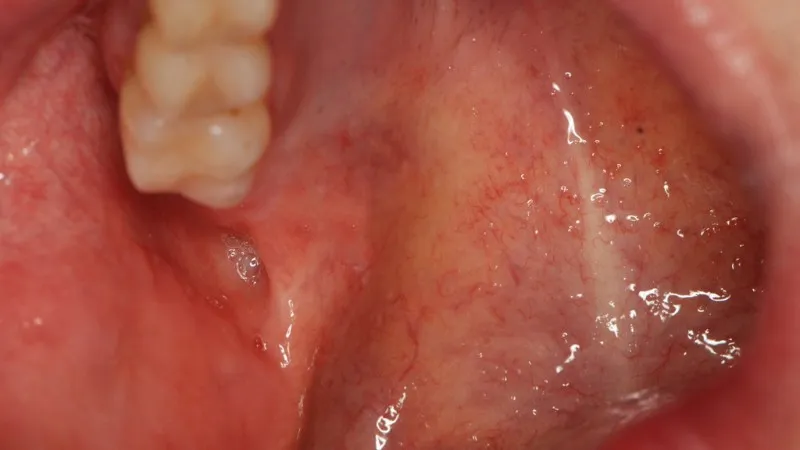 Zdjęcie Jak wygląda włókniak w jamie ustnej? Objawy i charakterystyka zmian