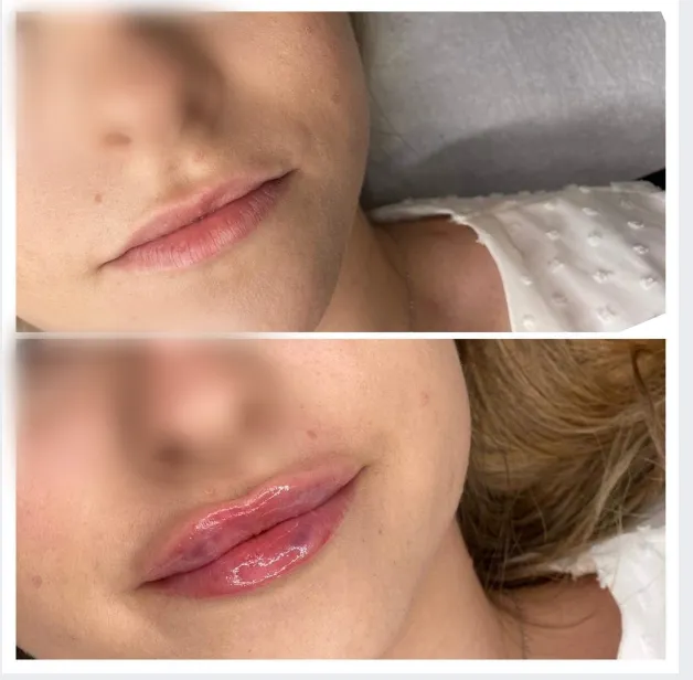 Zdjęcie Powiększanie ust w Krakowie - gdzie znaleźć najlepsze kliniki?