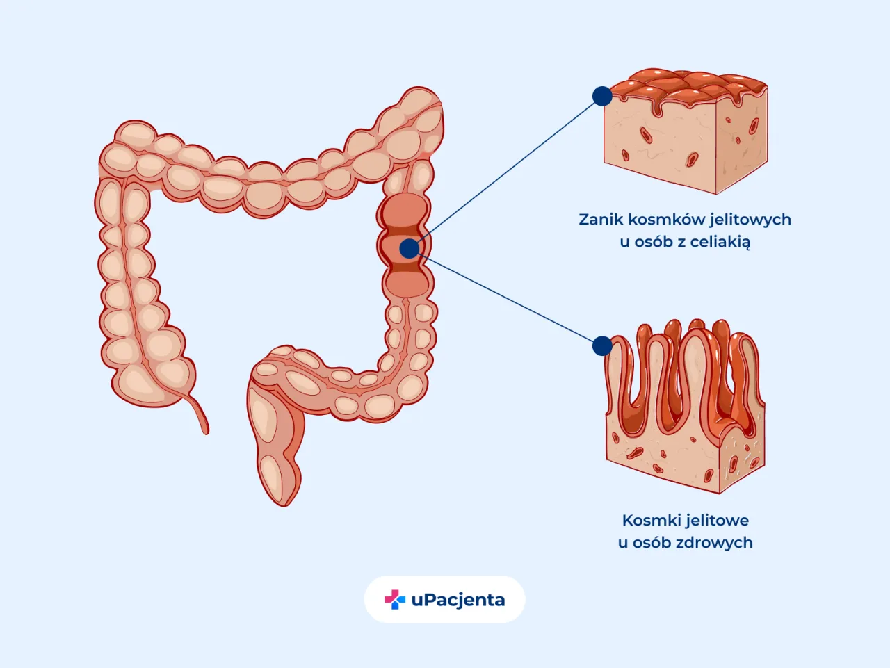 Zdjęcie Celiakia - badania krwi w diagnostyce choroby trzewnej