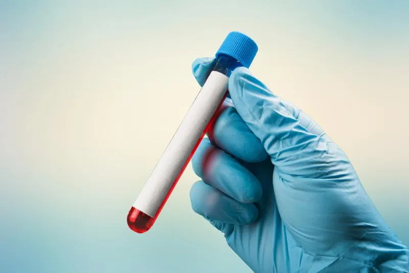 Zdjęcie Badanie krwi IG: kluczowe informacje o immunoglobulinach