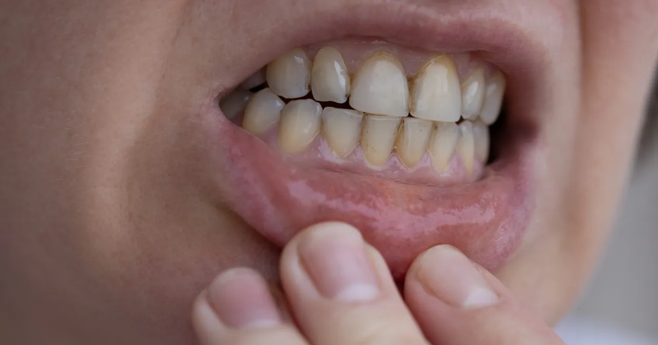 Zdjęcie Domowy kamień nazębny: Co działa, a co szkodzi? Sprawdź!