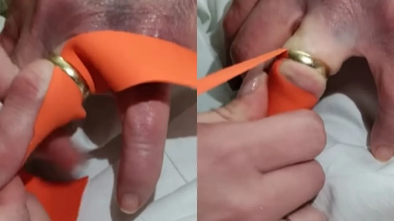 Zdjęcie Jak zdjąć obrączkę nitką i ulżyć sobie w bólu opuchniętego palca