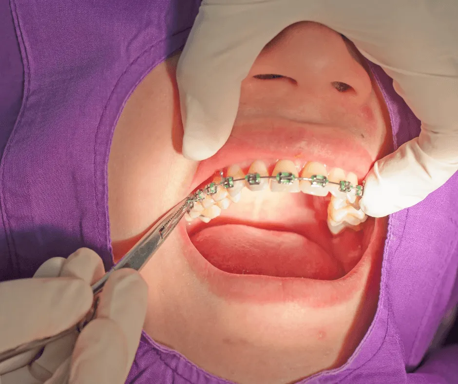 Zdjęcie Skuteczne metody na ból zębów przy aparacie ortodontycznym