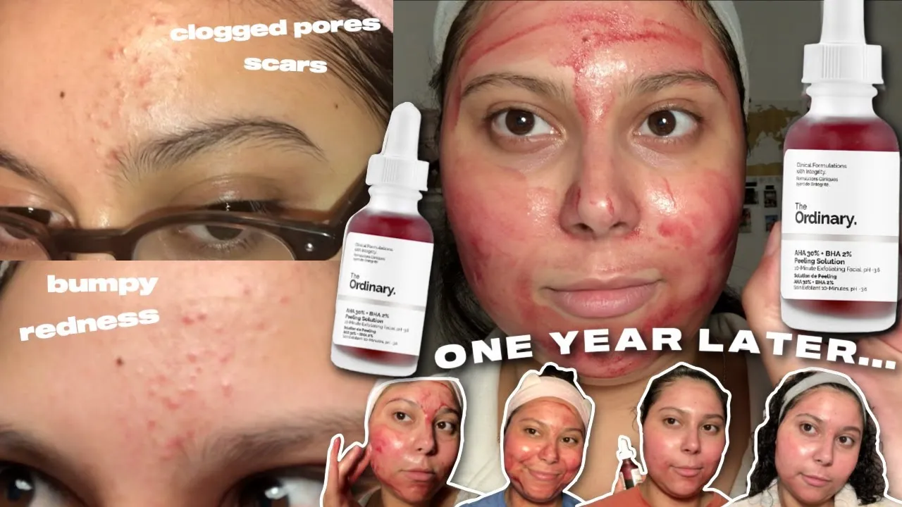 Zdjęcie The Ordinary krwawe peeling: jak bezpiecznie używać AHA 30% + BHA 2%