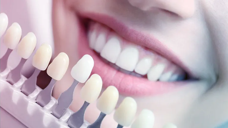 Zdjęcie Wybielanie zębów u dentysty – czy warto? Korzyści, ryzyka i efekty