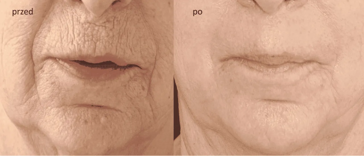 Zdjęcie Peeling fenolowy: ile trwa gojenie i jak przyspieszyć proces?