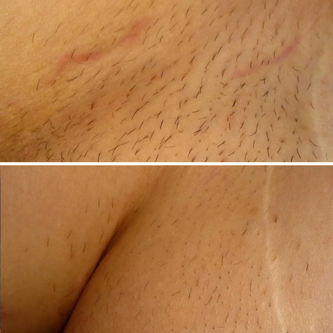 Zdjęcie Ile zabiegów laserem na bikini potrzebujesz, by osiągnąć efekt?