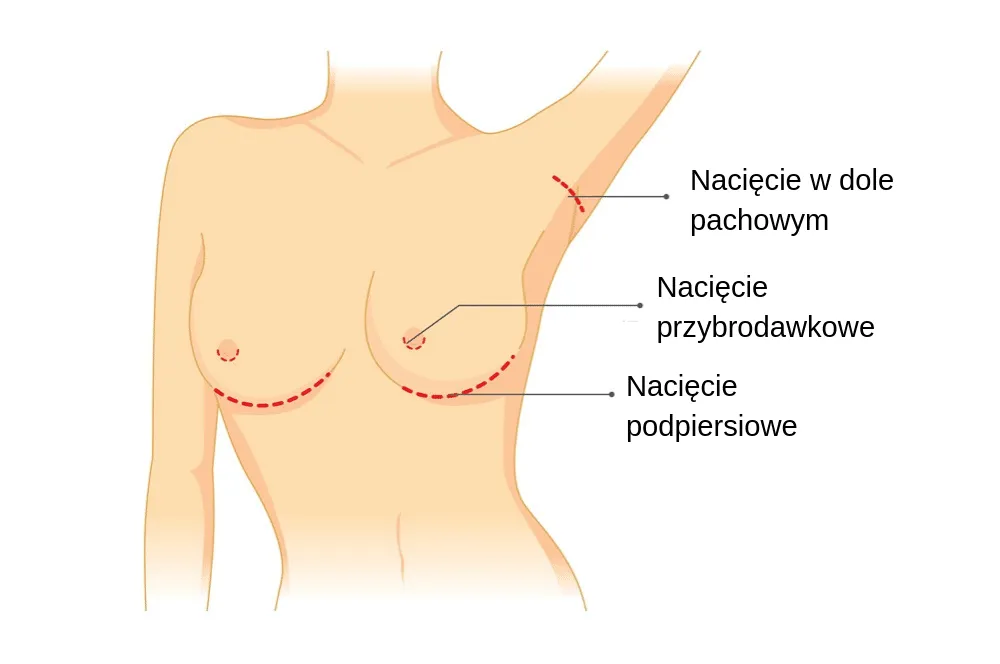 Zdjęcie Jak powiększyć sobie biust? Metody, zalety i skutki, które warto poznać