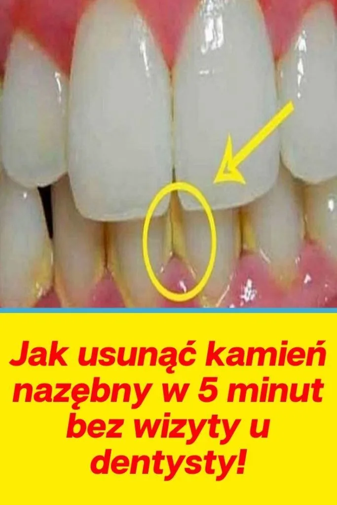 Zdjęcie Jak dentysta usuwa kamień nazębny? Proces, metody i co warto wiedzieć przed zabiegiem