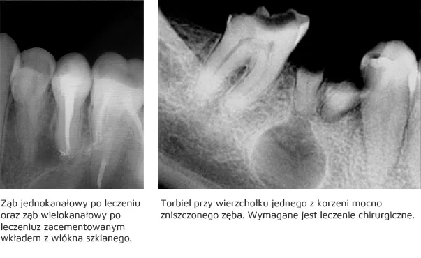 Zdjęcie Ile korzeni ma ząb? Zaskakujące różnice w budowie zębów