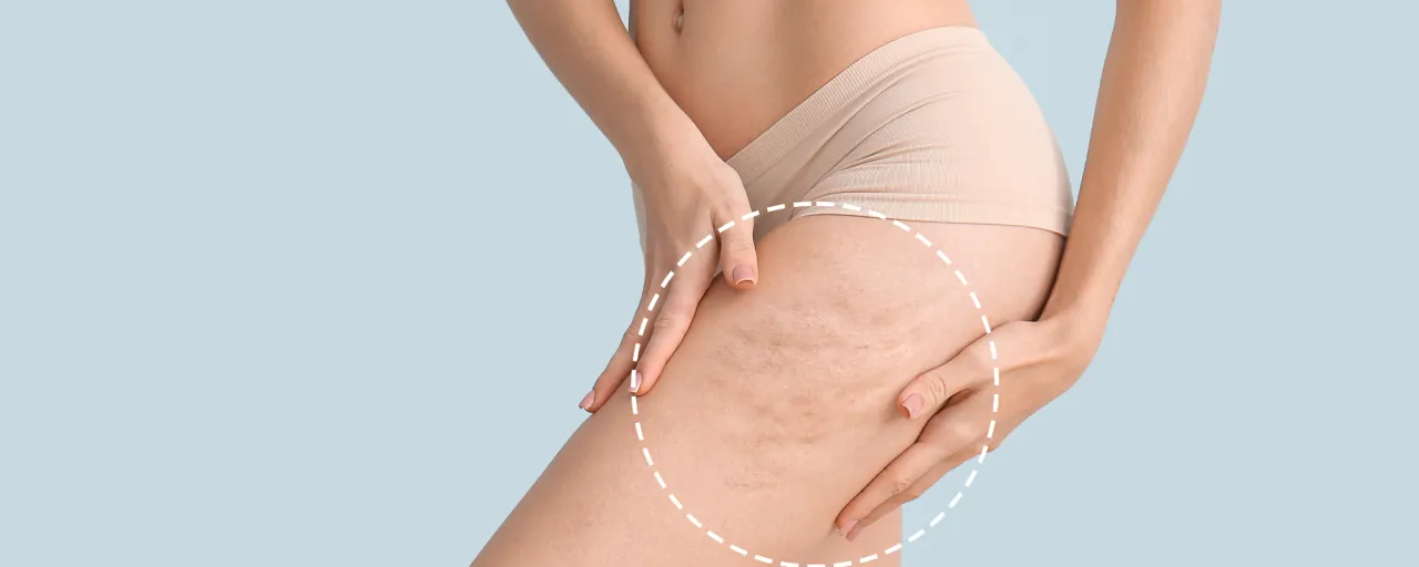 Zdjęcie Masaż antycellulitowy ile razy? Odkryj skuteczną częstotliwość zabiegów