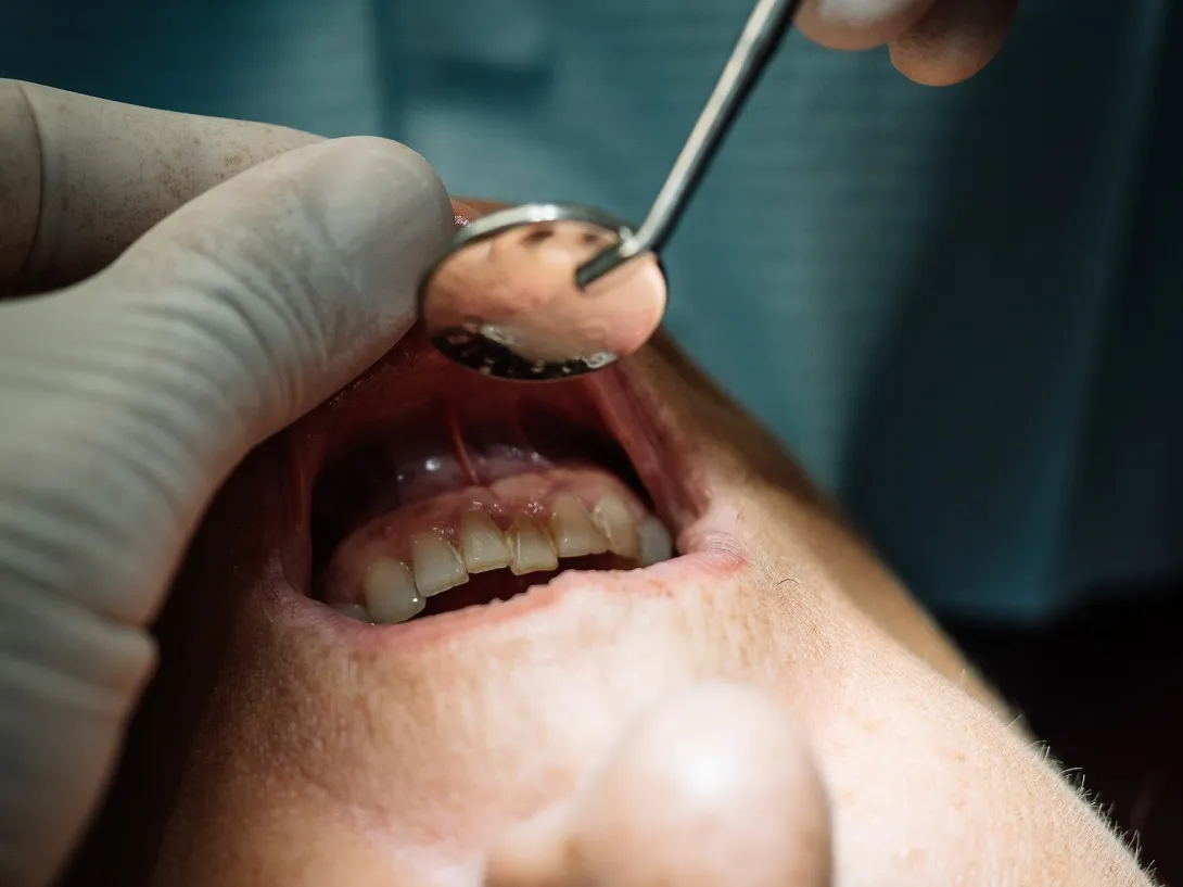 Zdjęcie Ile trwa znieczulenie u dentysty? Poznaj czas działania i skutki