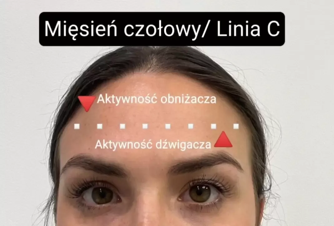 Zdjęcie Ile trzyma się botoks na czole? Fakty, które musisz znać