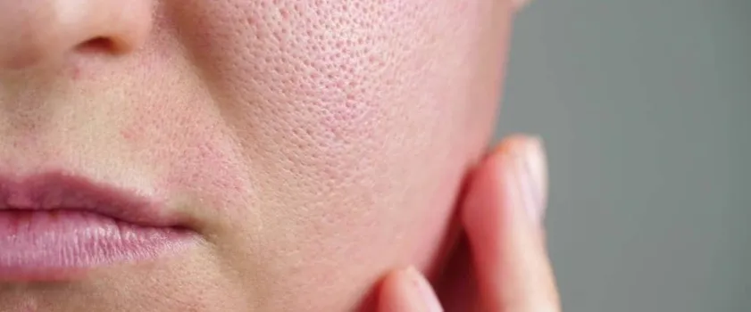 Zdjęcie Cera tłusta czego unikać: 10 błędów, które pogarszają stan skóry