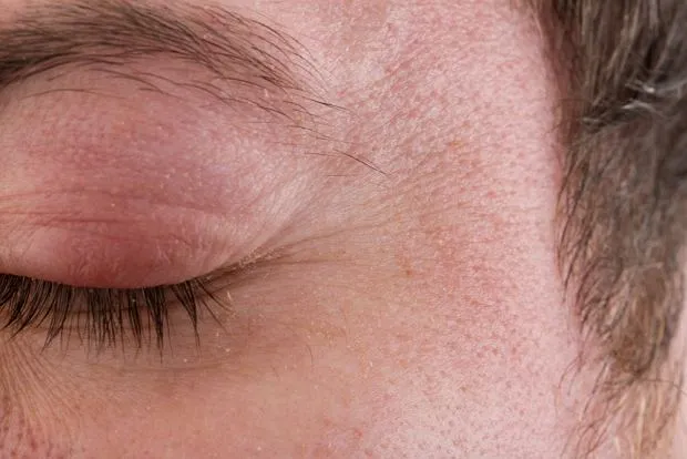Zdjęcie Choroby powiek: objawy i zdjęcia, które pomogą w identyfikacji
