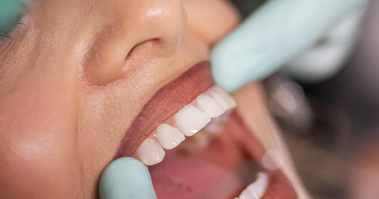 Zdjęcie Czy żelazo niszczy zęby? Sprawdź, jak uniknąć przebarwień