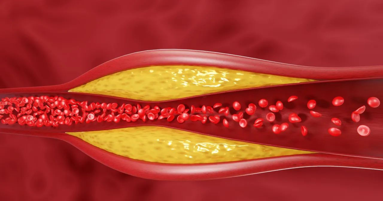 Zdjęcie Co jest przyczyną wysokiego cholesterolu i jak go skutecznie obniżyć