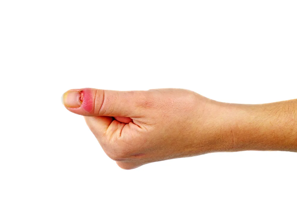 Zdjęcie Zanokcica jaki lekarz? Dowiedz się, kto pomoże w leczeniu tej dolegliwości